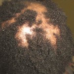 Alopecia, hair loss